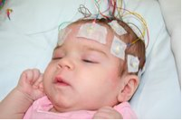 EEG Aicardi Syndrome.png