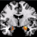 amygdala